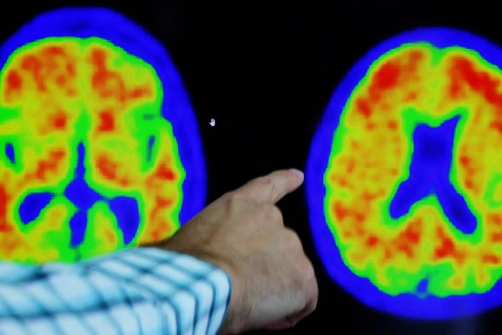 Teste sanguíneo para Alzheimer chega à rede privada com preços de até R$ 5.000